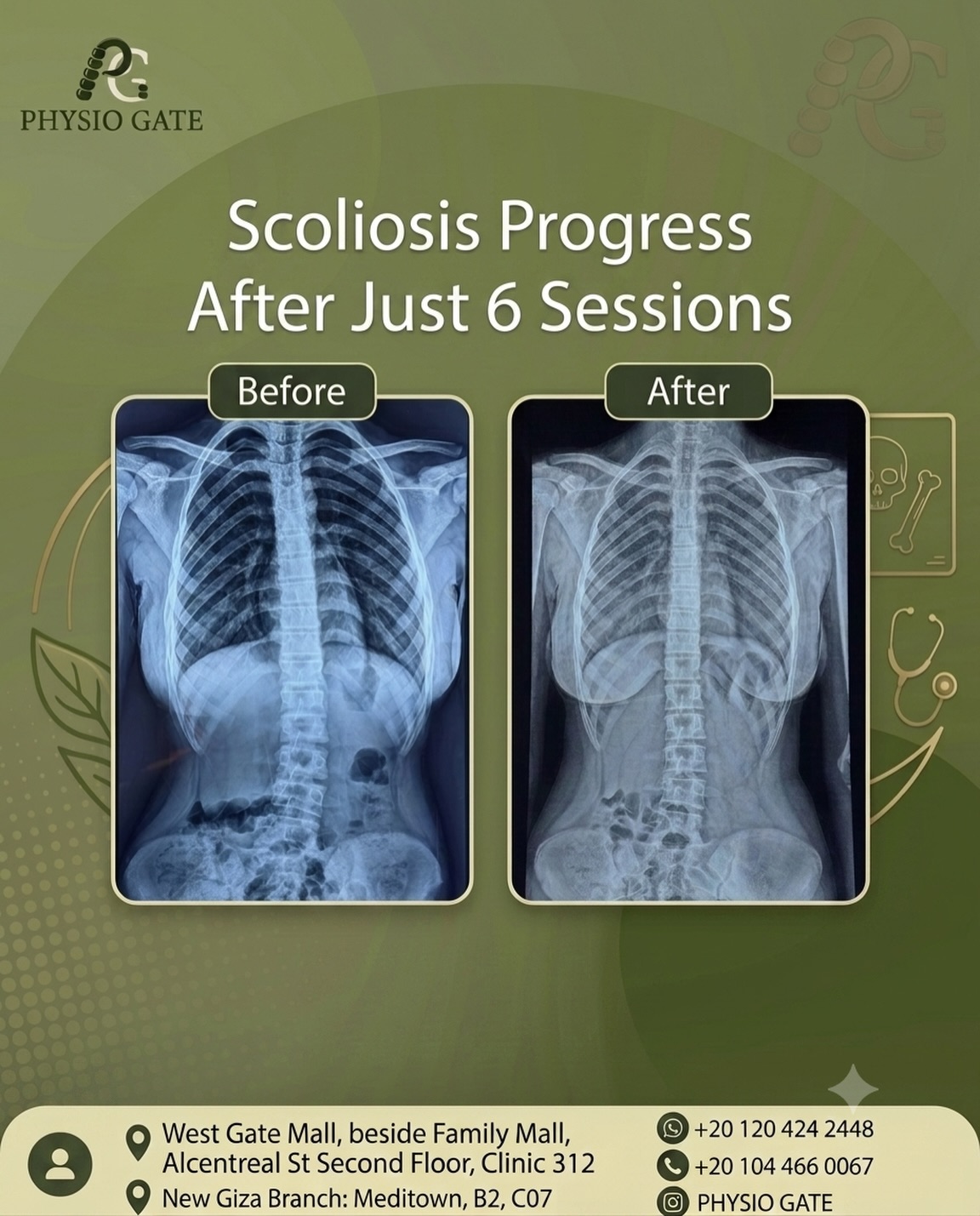 Scoliosis progress after six sessions, before and after X-rays